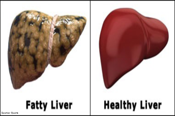 Fatty Liver: What is it and how to overcome it?